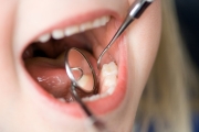 Замена молочных зубов